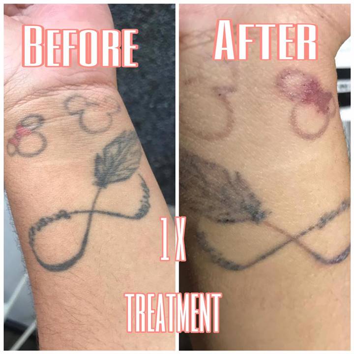 jasa hapus tato bali